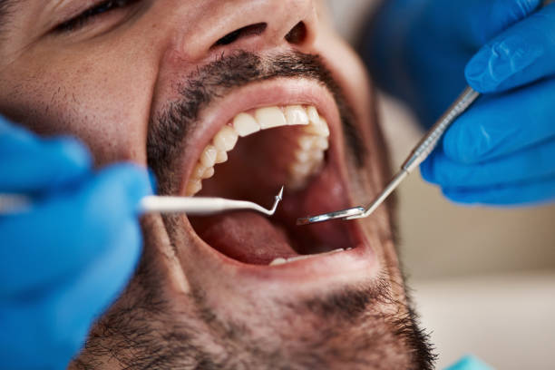 Best Emergency Wisdom Teeth Removal in Rolla, ND